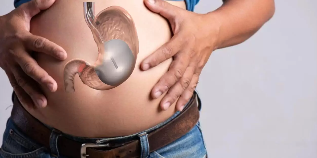 Gastric Balloon Placement