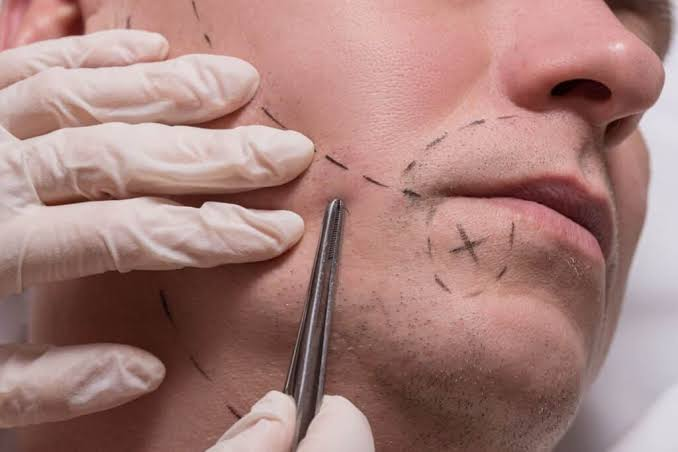 Mustache Hair Transplant