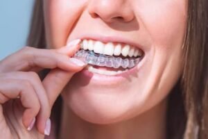 invaslign treatment