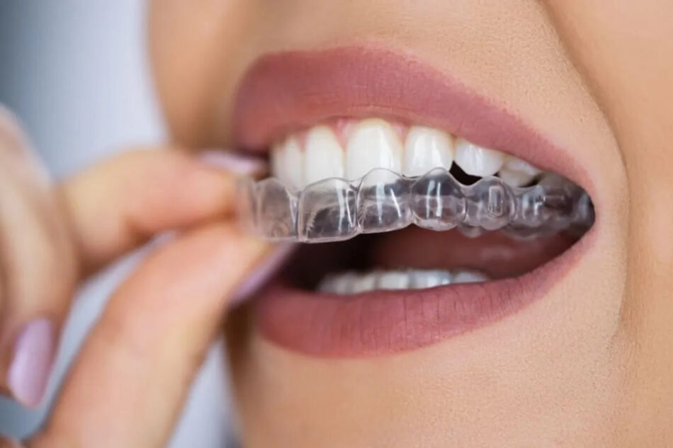invisible braces