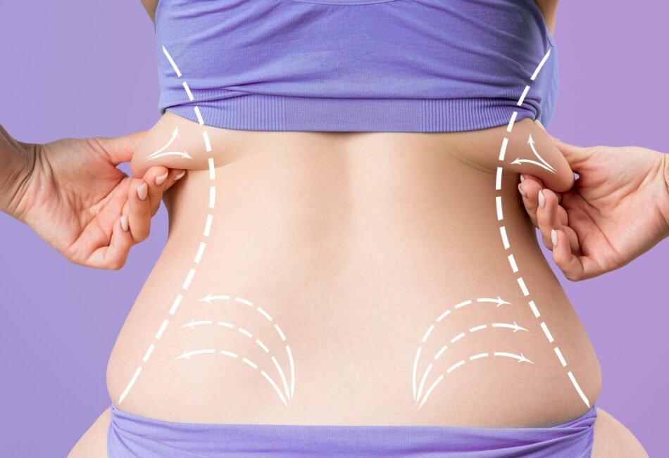 liposuction in Islamabad