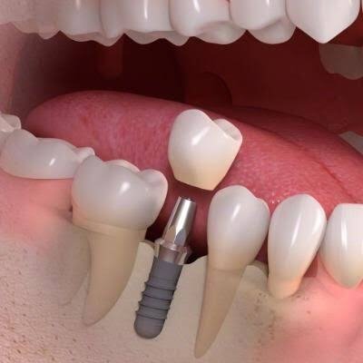 mandibular implant
