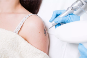Laser Tattoo Removal in Dubai
