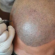 Can Scalp Micropigmentation improve confidence