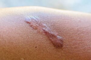 Can laser treatment treat hypertrophic scars?