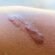 Can laser treatment treat hypertrophic scars?
