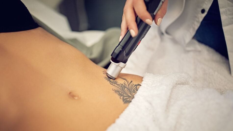 Tattoo Removal Dubai