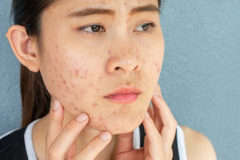 Acne Treatment in Dubai