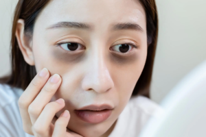 Dark Circles Treatment in Dubai