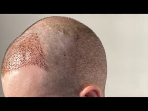 What is the price of a hair transplant?