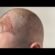 What is the price of a hair transplant?