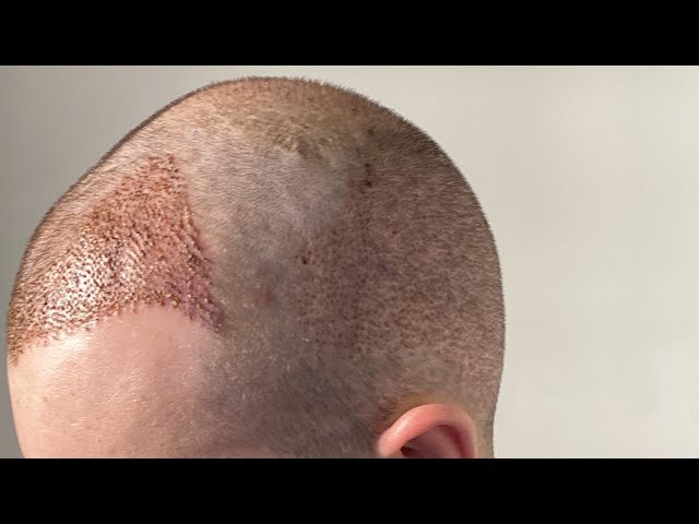 What is the price of a hair transplant?