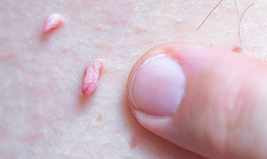 Who is a good candidate for Skin Tag Removal?