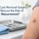 Can Cyst Removal Surgery Help Reduce the Risk of Cyst Recurrence