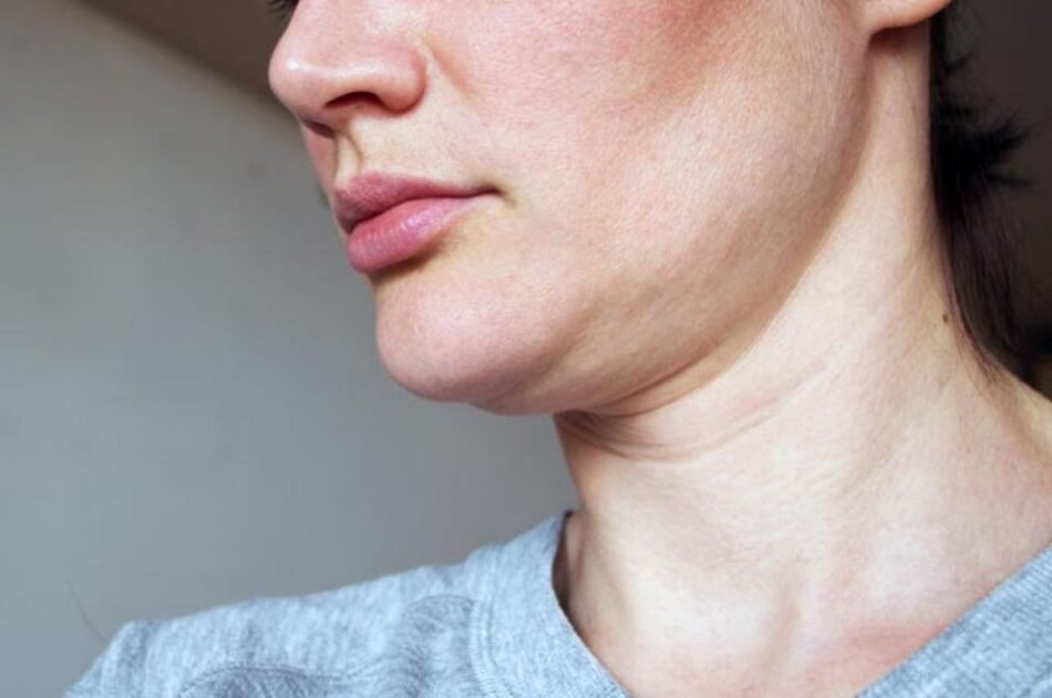 Double Chin Liposuction Dubai