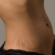 Stretch Marks Removal in Dubai