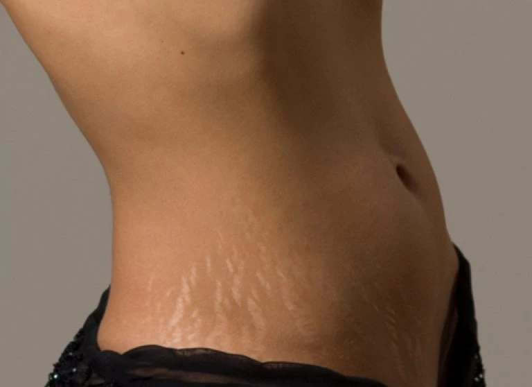 Stretch Marks Removal in Dubai