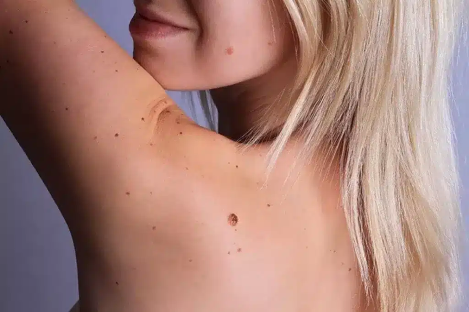 Wart Removal in Dubai