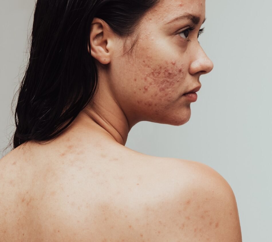 Facial Scar Treatment