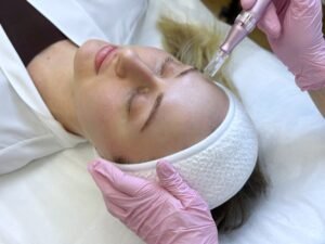 Microneedling Dubai