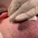 How long do FUE Hair Transplant results last?