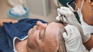 Fue Hair Transplant in Dubai