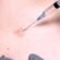 Keloid Treatment Abu Dhabi