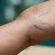 Sclerotherapy in Abu Dhabi