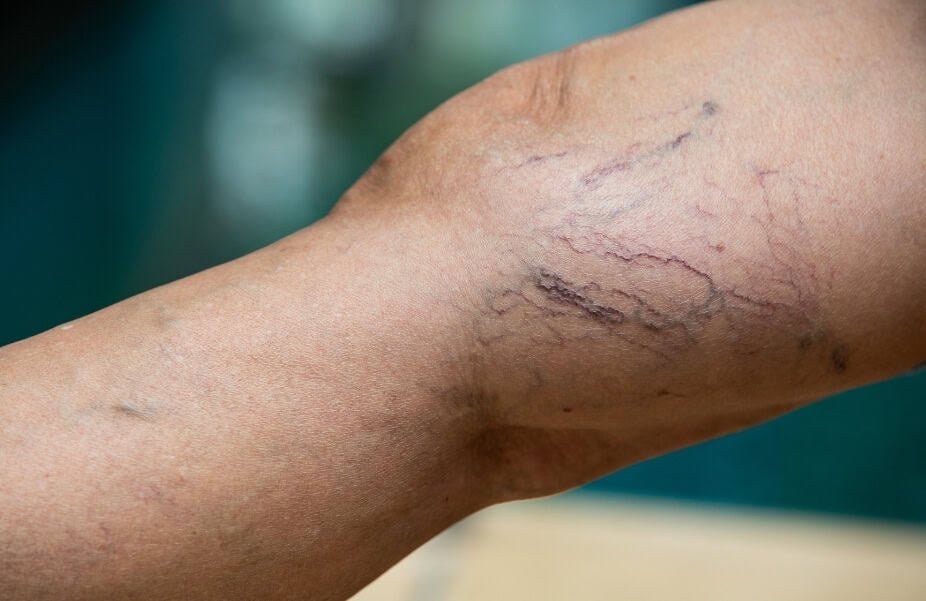 Sclerotherapy in Abu Dhabi