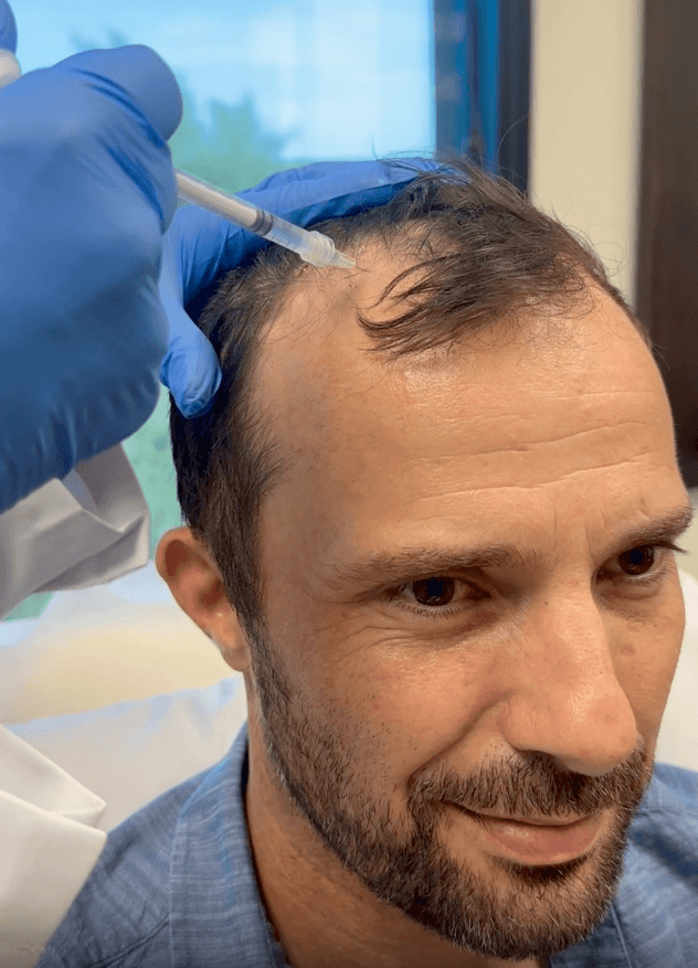 Stem Cell Hair Transplant in Abu Dhabi