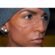 Facial Scar Treatment Dubai