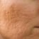 Facial Scar Revision Dubai