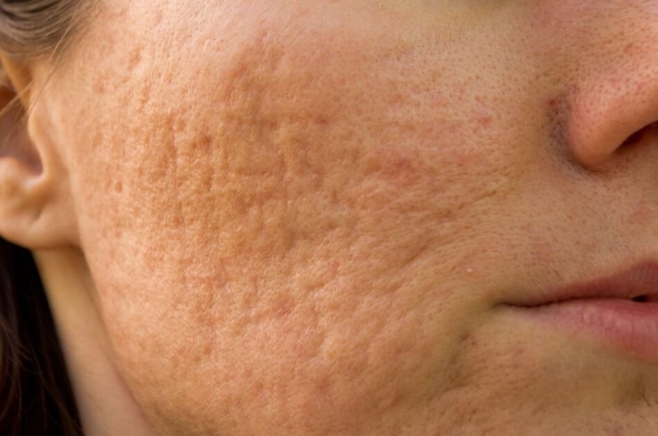 Facial Scar Revision Dubai