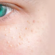 What professional treatment removes adult milia?
