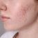 Acne Treatment in Dubai