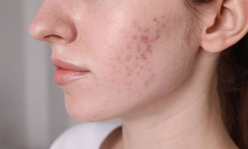 Acne Treatment in Dubai