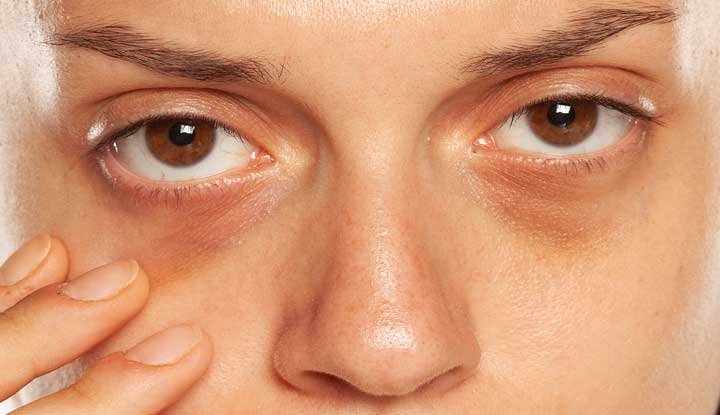 Dark Circle Treatment Cost in Dubai