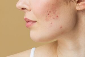 Pimples Treatment in Dubai