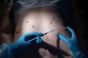 Gynaecomastia in Dubai