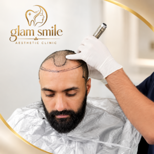 Hair Transplant in Islamabad