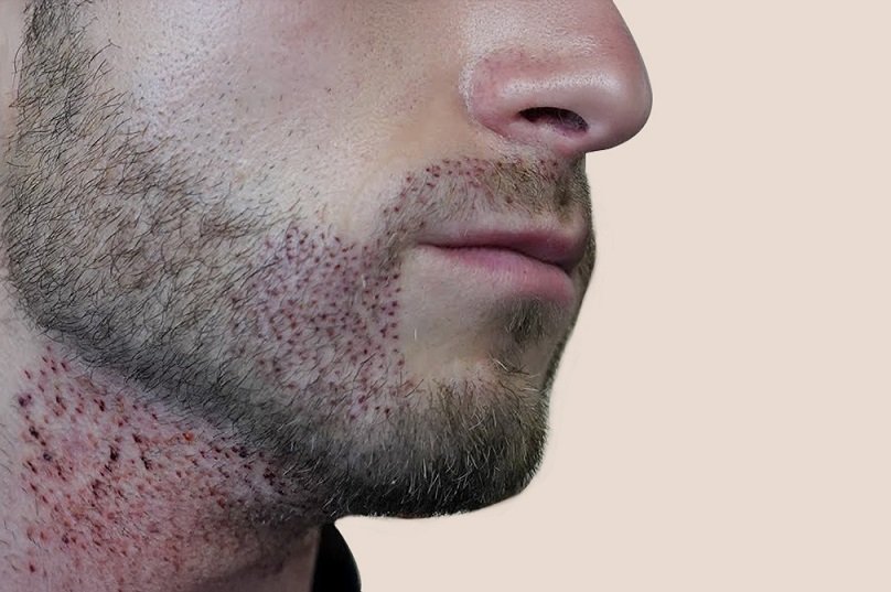 Is Beard Hair Transplant suitable for thin beards?