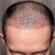 Is a hair transplant suitable for men and women?