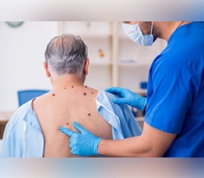 Seborrheic Keratosis Remedies and warning signs that require a dermatologist's assessment