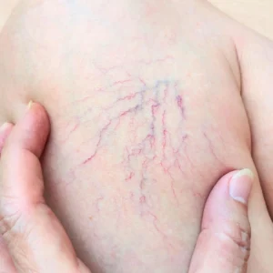 Spider-Veins