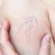 Spider-Veins